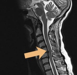 Spinalstenose / Spinalkanalstenose | Beta Klinik Bonn